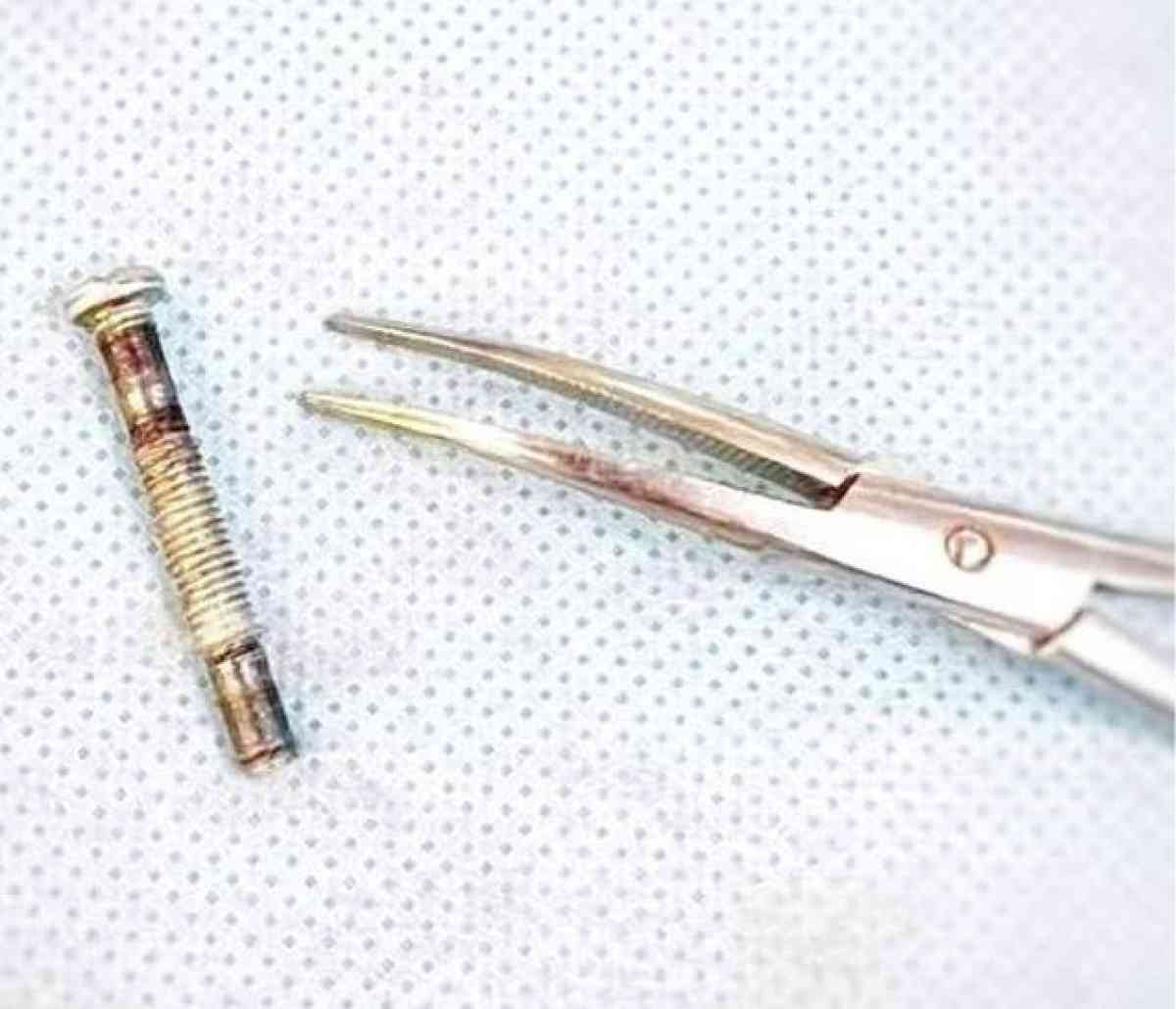 Дәрігерлер төрт сантиметрлік болт жұтып қойған сәбиді аман алып қалды